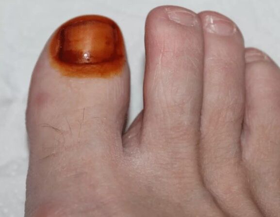 Tratamento do iodo de fungos