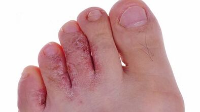 Tipos e etapas do desenvolvemento de fungos nas pernas