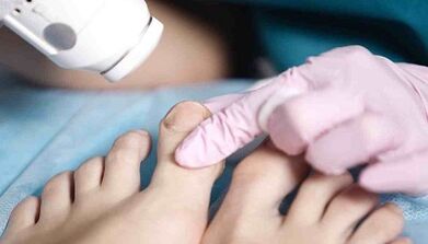 Tratamento de hardware do fungo nas pernas