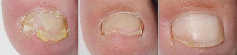 Resultados da terapia