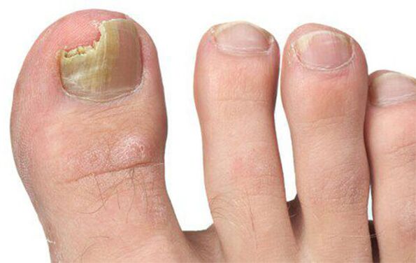 Varias formas de fungo