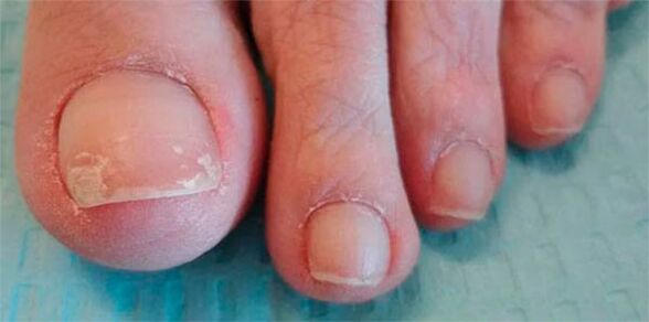 etapas das patas fúngicas