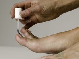 Tratamento do fungo das uñas