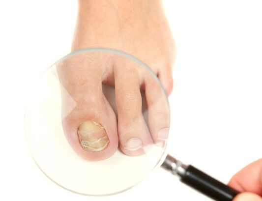 fungo das unhas dos pés