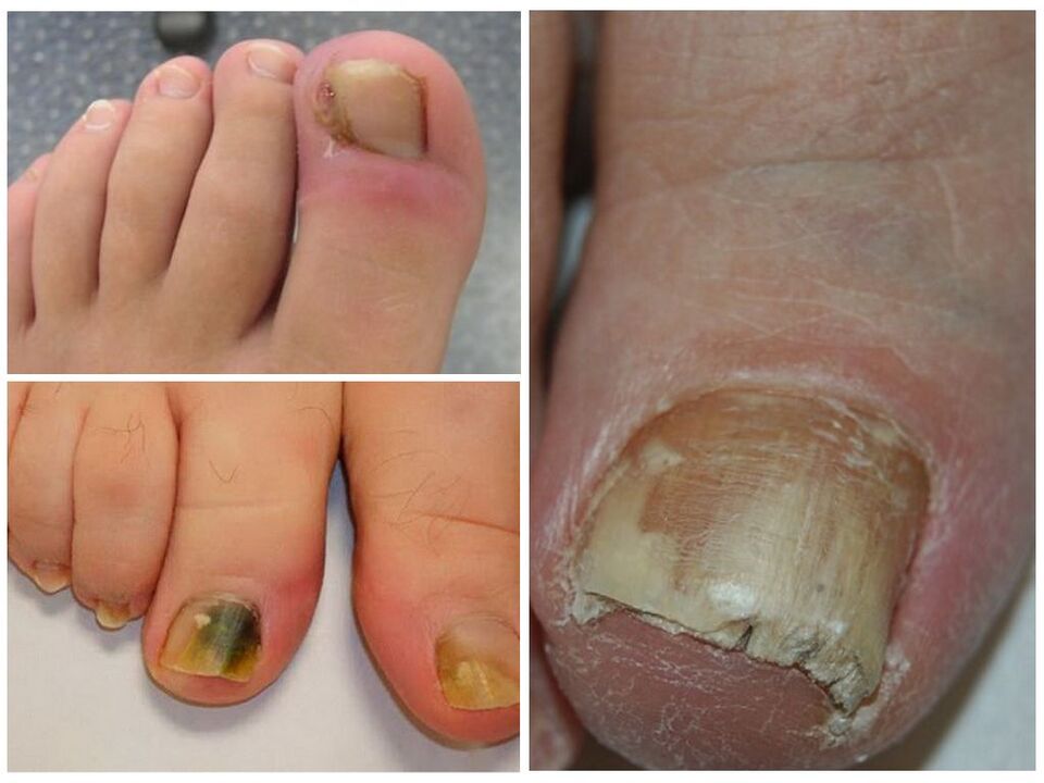 infección por fungos das unhas dos pés