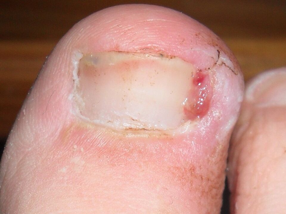 unha encarnada do pé como síntoma dunha infección por fungos