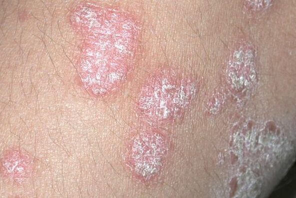 Psoríase causada por unha infección fúngica
