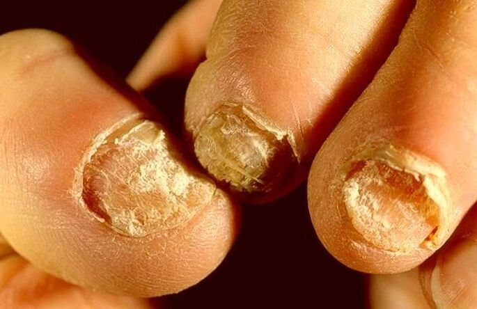 fungo das unhas como tratar