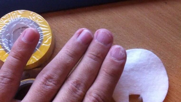 fungo das unhas e o seu tratamento con remedios populares