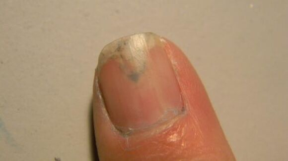 síntomas de fungos nas unhas