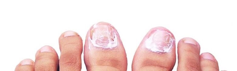 ungüento para unhas fungos