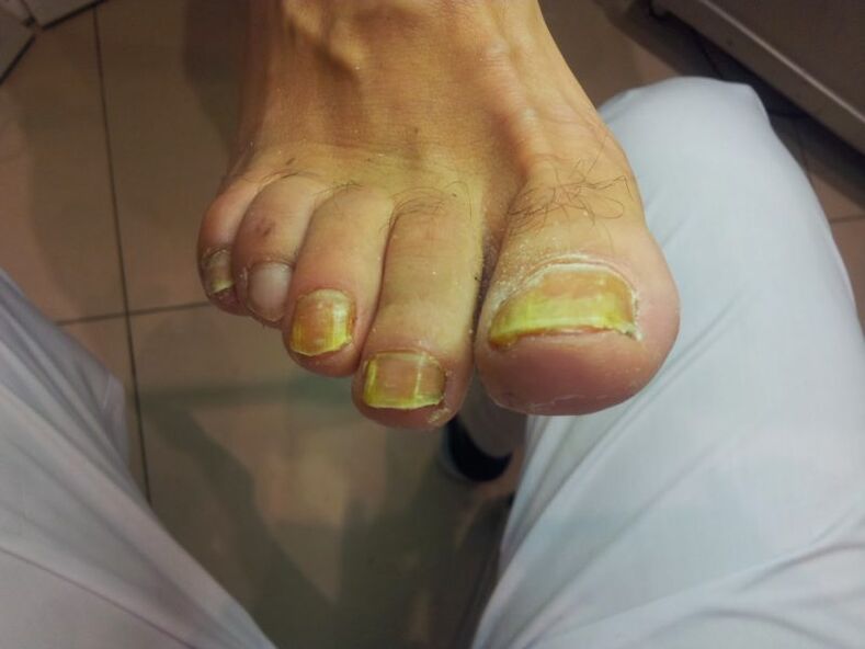 unhas amarelas dos pés por fungo