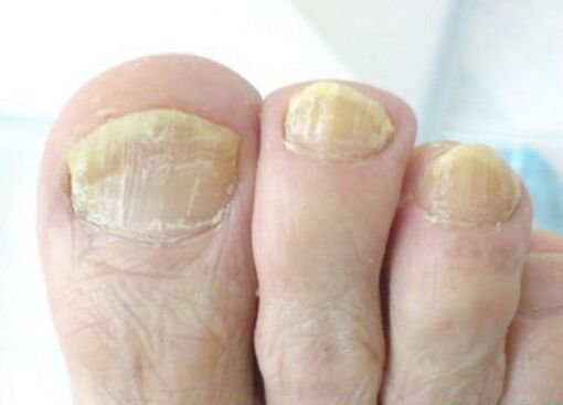 fungo avanzado nas unhas dos pés